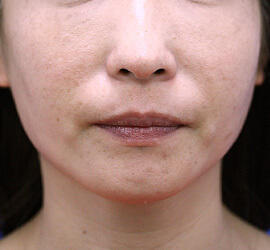 40代女性のヒアルロン酸注射  After 症例写真