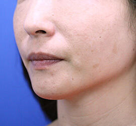 40代女性のヒアルロン酸注射（ゴルゴライン） After 症例写真