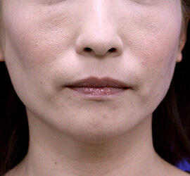 40代女性のヒアルロン酸注射  Before 症例写真