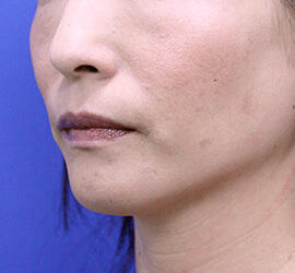 40代女性のヒアルロン酸注射（ゴルゴライン） Before 症例写真