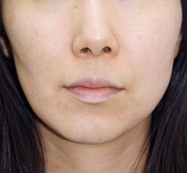 40代女性のレーザートーニング After 症例写真