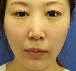 30代女性の3Dリポアイリフト  After 症例写真