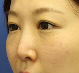 30代女性の3Dリポアイリフト  After 症例写真