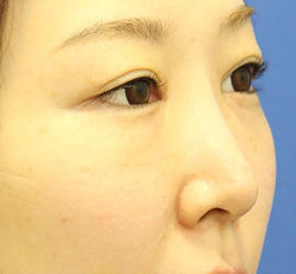 30代女性の3Dリポアイリフト  After 症例写真