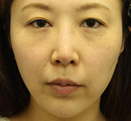 30代女性の3Dリポアイリフト  Before 症例写真