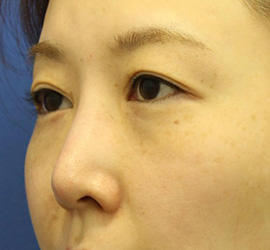 30代女性の3Dリポアイリフト  Before 症例写真