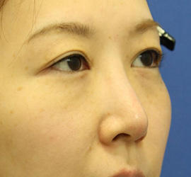 30代女性の3Dリポアイリフト  Before 症例写真