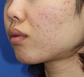 20代女性のメディカル美肌セレクト After 症例写真