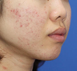 20代女性のメディカル美肌セレクト After 症例写真