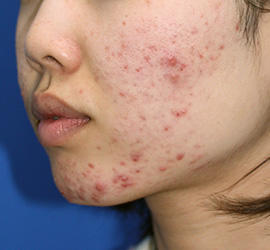 20代女性のメディカル美肌セレクト Before 症例写真