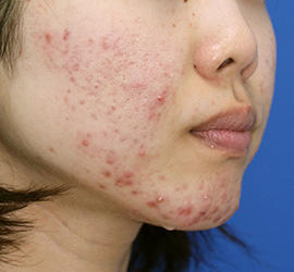 20代女性のメディカル美肌セレクト Before 症例写真