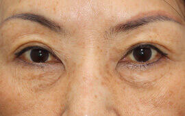 50代女性の二重埋没法 After 症例写真