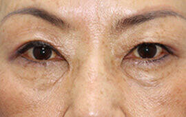 50代女性の二重埋没法 Before 症例写真