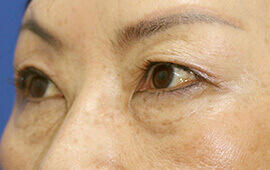 50代女性の二重埋没法 Before 症例写真