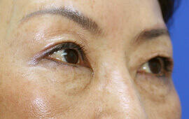 50代女性の二重埋没法 Before 症例写真