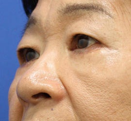 60代女性の下まぶたのたるみ取り After 症例写真