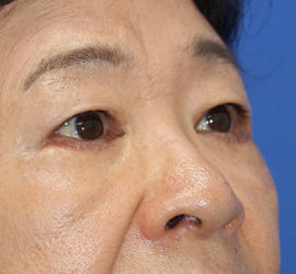 60代女性の下まぶたのたるみ取り After 症例写真