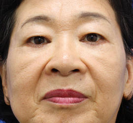 60代女性のPRP皮膚再生療法 After 症例写真