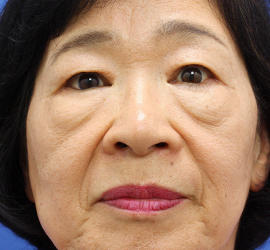 60代女性のPRP皮膚再生療法 Before 症例写真