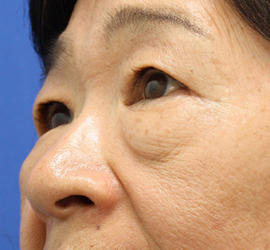60代女性の下まぶたのたるみ取り Before 症例写真