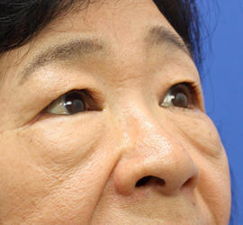 60代女性の下まぶたのたるみ取り Before 症例写真