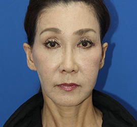 60代女性のチークリフト・フェイスリフト After 症例写真