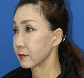 60代女性のチークリフト・フェイスリフト After 症例写真