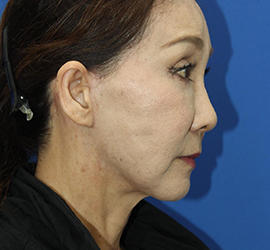 60代女性のチークリフト・フェイスリフト After 症例写真