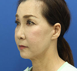 60代女性のチークリフト・フェイスリフト Before 症例写真