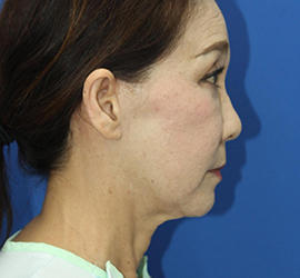 60代女性のチークリフト・フェイスリフト Before 症例写真