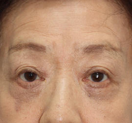 60代女性のPRP皮膚再生療法 After 症例写真