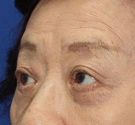 60代女性の下まぶたのたるみ取り After 症例写真
