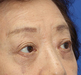 60代女性の下まぶたのたるみ取り After 症例写真