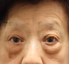 60代女性のPRP皮膚再生療法 Before 症例写真