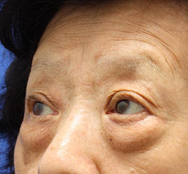 60代女性の下まぶたのたるみ取り Before 症例写真