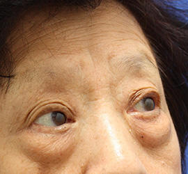 60代女性の下まぶたのたるみ取り Before 症例写真