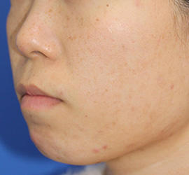 20代女性のメディカル美肌セレクト After 症例写真