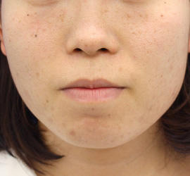 20代女性のメディカル美肌セレクト Before 症例写真
