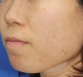 20代女性のメディカル美肌セレクト Before 症例写真