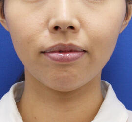 30代女性のヒアルロン酸注射(アゴ形成) After 症例写真