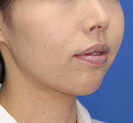 30代女性のヒアルロン酸注射(アゴ形成) After 症例写真