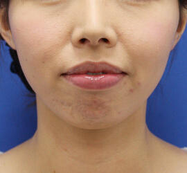 30代女性のヒアルロン酸注射(アゴ形成) Before 症例写真
