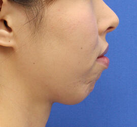30代女性のボトックス(アゴ) Before 症例写真