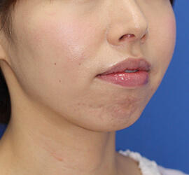 30代女性のヒアルロン酸注射(アゴ形成) Before 症例写真