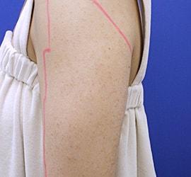 20代女性の毛孔性苔癬・角化症 Before 症例写真