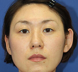 30代女性の3Dリポアイリフト  After 症例写真