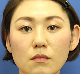 30代女性の3Dリポアイリフト After 症例写真