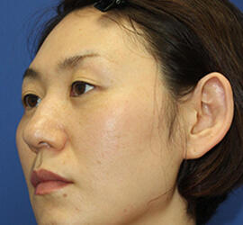 30代女性の3Dリポアイリフト  After 症例写真