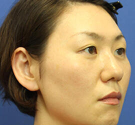 30代女性の3Dリポアイリフト  After 症例写真