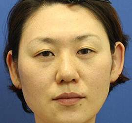 30代女性の3Dリポアイリフト  Before 症例写真